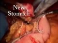 Removal of the LapBand and Conversion to Mini-Gastric Bypass