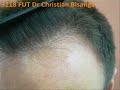 Dr Bisanga 3218 FUT with Tricophytic Closure Dr Bisanga 3218 FUT with Tricophytic Closure