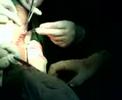 debridement debridement