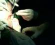 debridement