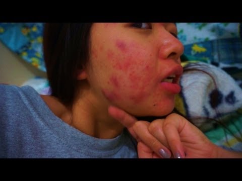 My Acne Story: 20th week of Accutane