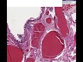Histopathology Anus --Hemorrhoids Histopathology Anus --Hemorrhoids