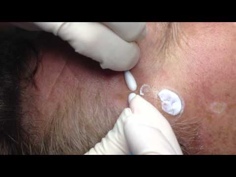 how to get rid of sebaceous hyperplasia