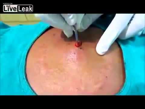 how to drain mrsa abscess