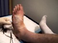 Removing Stiches & Pins from Foot