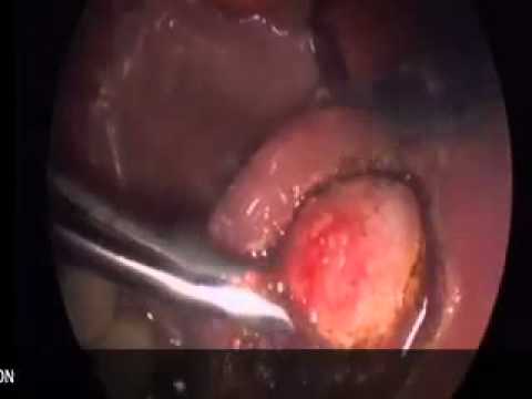 how to treat leukoplakia