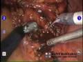 Robotic Sacral Culpopexy --conducted by Dr. Emad Hashemi
