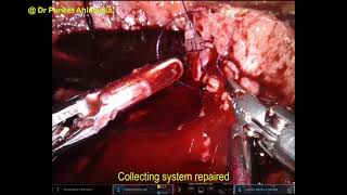 Robotic Right Partial Nephrectomy (heminephrectomy) for T2b mass