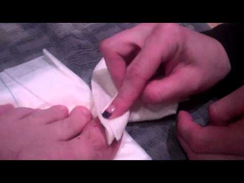 how to drain subungual hematoma