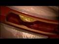 Cholesterol Overview