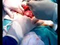 Mioma-Tumor Benigno de células musculares lisas do Utero