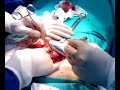 Mioma-Tumor Benigno de células musculares lisas do Utero