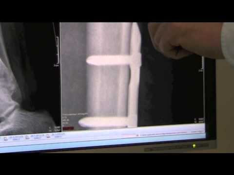 how to treat x shaped legs