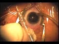 1.8mm Tetraflex Implantation