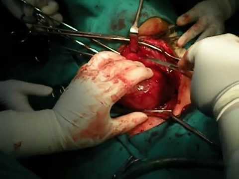 how to cure euthyroid