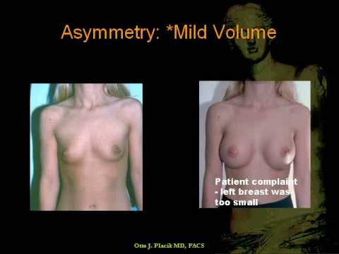 puffy breast