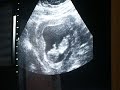 12 week sonogram part 2