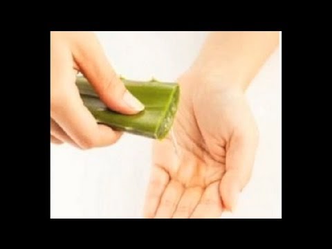 how to cure sunburn