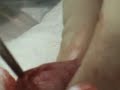 Cistotomia para retirada de c�lculo de bexiga