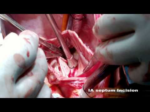 Vidéo 1