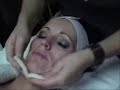 Microdermabrasion