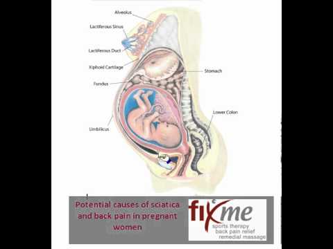 how to relieve sciatica in pregnancy