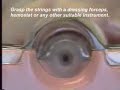 IUD removal IUD removal