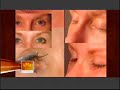 NBC TODAY Show #2 - Eyelash Transplants NBC TODAY Show #2 - Eyelash Transplants