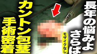 【リアル手術】長年悩み続けたカントン包茎ペニス。決意の手術をノーカットで。【モザイクなし】
