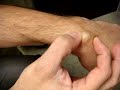Ganglion Cyst removal - any MCSE book will do
