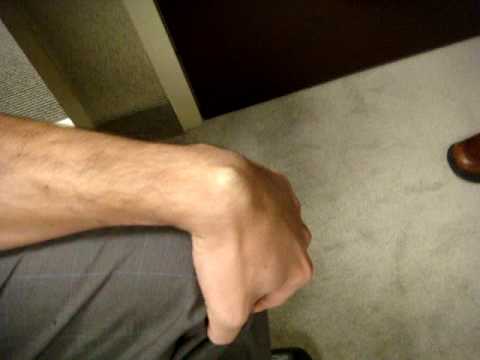 how to treat ganglion cyst
