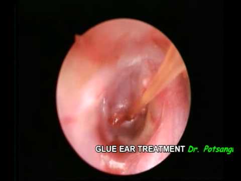 how to relieve glue ear