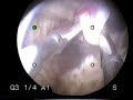 hysteroscopy-submucous-leiomyoma-fibroid.html