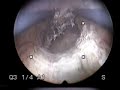 Hysteroscopy - submucous leiomyoma (fibroid)