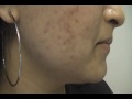 The Acne Practice  (Blackheads and Acne 1)