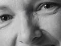 Revision Rhinoplasty -- Wisconsin -- Sheboygan and Milwaukee