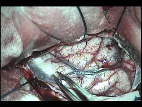 Epilepsy Surgery: Right Temporal Lobectomy for Mesial Temporal Sclerosis