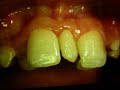 Clinical Pediatric Dentistry; Etiology of Supernumerary Teeth
