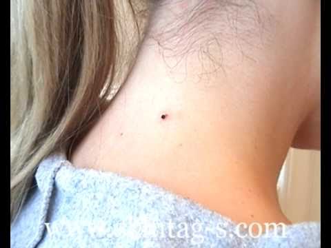 how to remove skin tags at home with vinegar