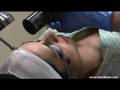 Microlaser Peel at Advanced Laser of Long Island in New York