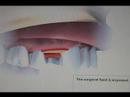 Dental implants procedure video(anim) using bone compression