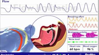 What is Sleep Apnea