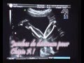 Echographie 5 mois - 27 09 07