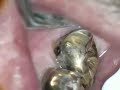 Class V posterior crown repair with Erbium laser Class V posterior crown repair with Erbium laser