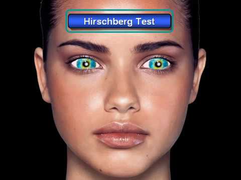 how to perform hirschberg test