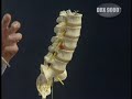 Opinion from spinal surgeon on DRX 9000