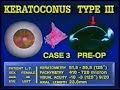 Ark -mini ARK - prima parte Radial Keratotomy