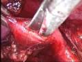 Ureteric Stone