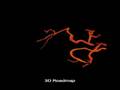 Medical Imaging: Motion Compensation for Catheterizations