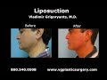 Los Angeles liposuction by Dr. Vladimir Grigoryants Los Angeles liposuction by Dr. Vladimir Grigoryants